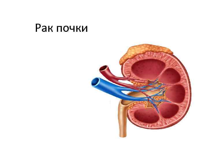 Рак почки 