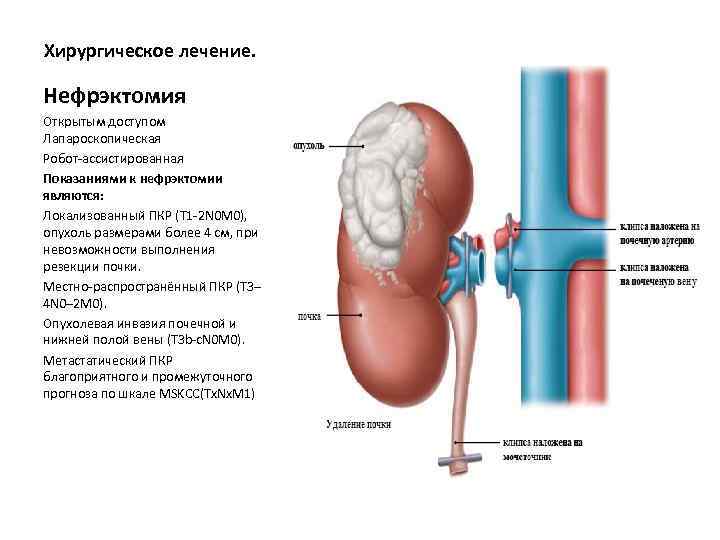 Хирургическое лечение. Нефрэктомия Открытым доступом Лапароскопическая Робот-ассистированная Показаниями к нефрэктомии являются: Локализованный ПКР (T