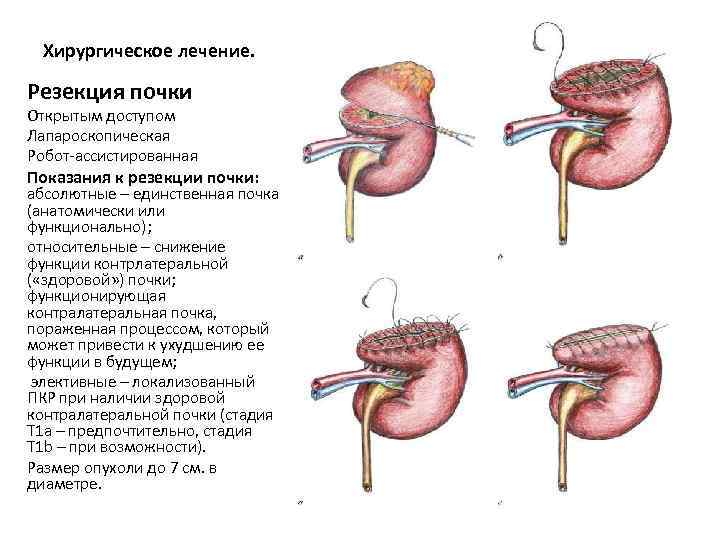 Хирургическое лечение. Резекция почки Открытым доступом Лапароскопическая Робот-ассистированная Показания к резекции почки: абсолютные –