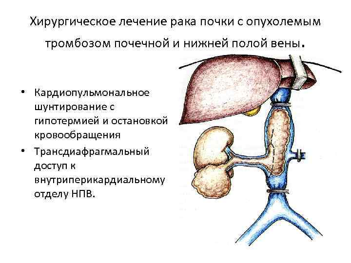 Хирургическое лечение рака почки с опухолемым тромбозом почечной и нижней полой вены. • Кардиопульмональное