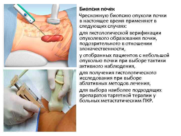  • Биопсия почек Чрескожную биопсию опухоли почки в настоящее время применяют в следующих