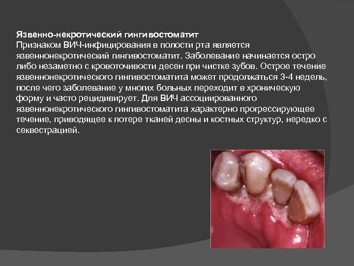 Язвенно-некротический гингивостоматит Признаком ВИЧ-инфицирования в полости рта является язвеннонекротический гингивостоматит. Заболевание начинается остро либо