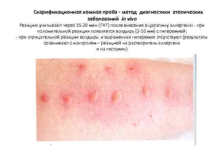 Скарификационная кожная проба - метод диагностики атопических заболеваний in vivo Реакцию учитывают через 15