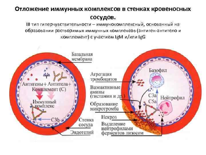 Отложение иммунных комплексов в стенках кровеносных сосудов. III тип гиперчувствительности – иммунокомплексный, основанный на