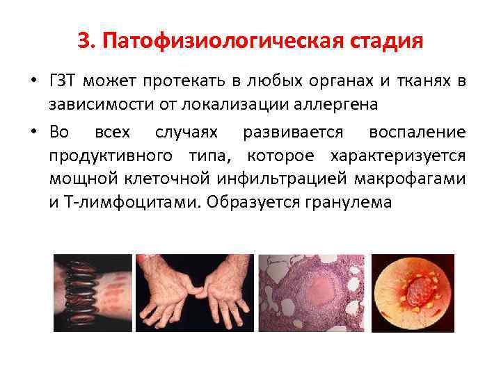 3. Патофизиологическая стадия • ГЗТ может протекать в любых органах и тканях в зависимости