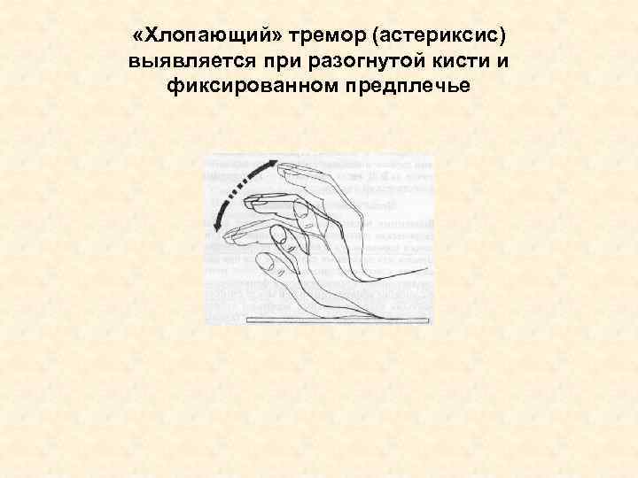  «Хлопающий» тремор (астериксис) выявляется при разогнутой кисти и фиксированном предплечье 