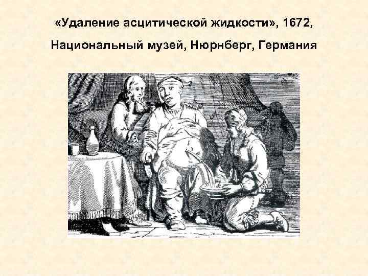  «Удаление асцитической жидкости» , 1672, Национальный музей, Нюрнберг, Германия 