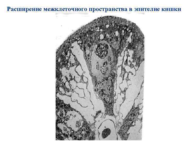 Расширение межклеточного пространства в эпителие кишки 