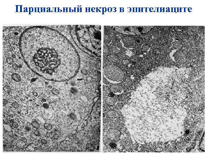 Парциальный некроз в эпителиаците 