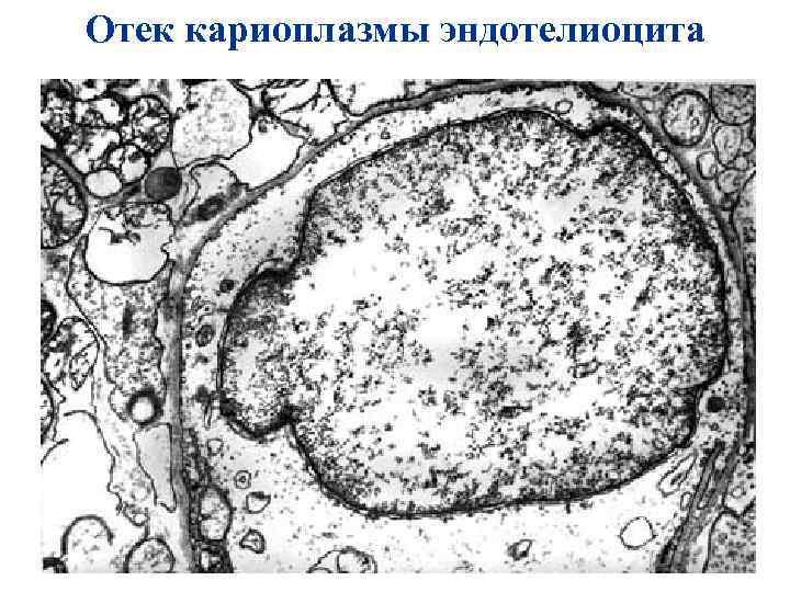 Отек кариоплазмы эндотелиоцита 