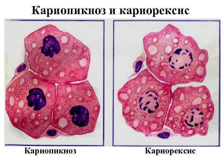 Кариопикноз и кариорексис Кариопикноз Кариорексис 