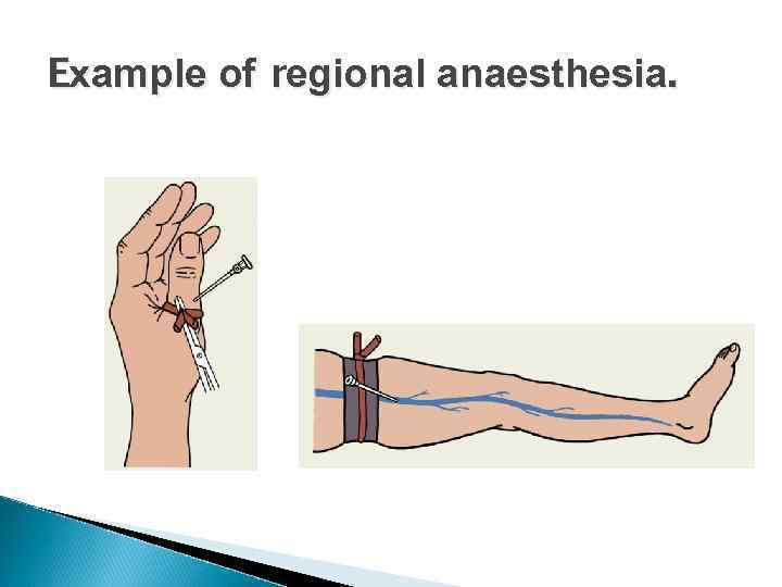 Example of regional anaesthesia. 