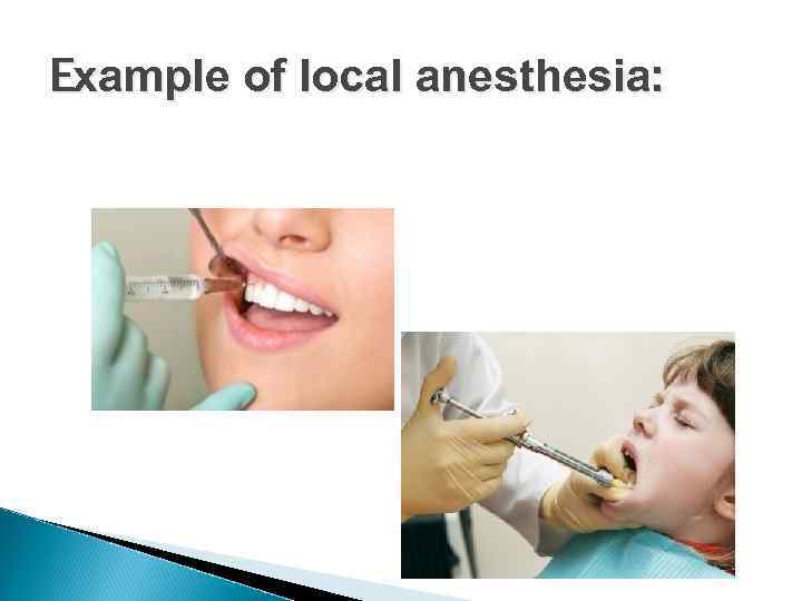 Example of local anesthesia: 