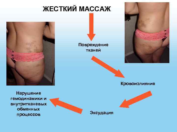 ЖЕСТКИЙ МАССАЖ Повреждение тканей Кровоизлияние Нарушение гемодинамики и внутритканевых обменных процессов Эксудация 