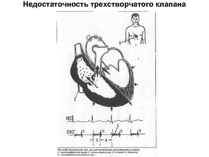 Недостаточность трехстворчатого клапана рисунок