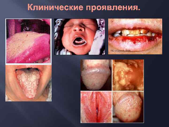 Клинические проявления. 