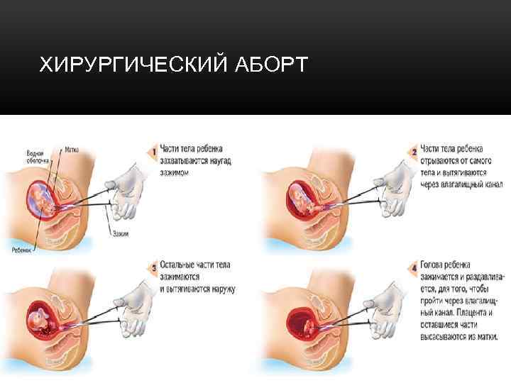 ХИРУРГИЧЕСКИЙ АБОРТ 