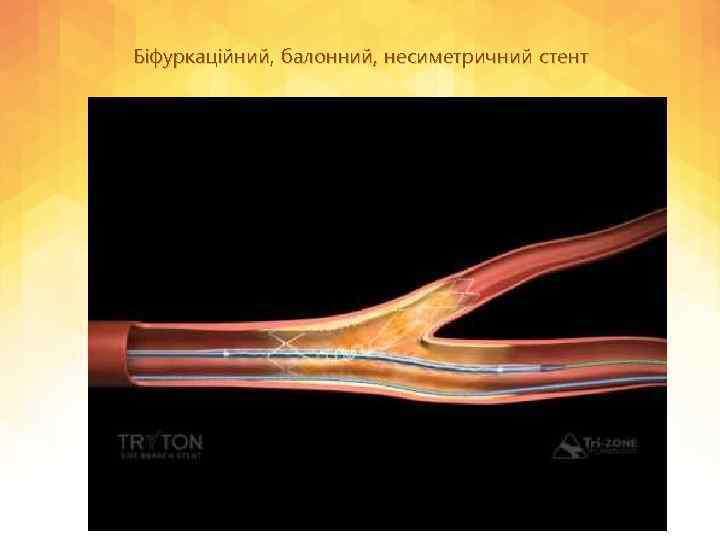 Біфуркаційний, балонний, несиметричний стент 