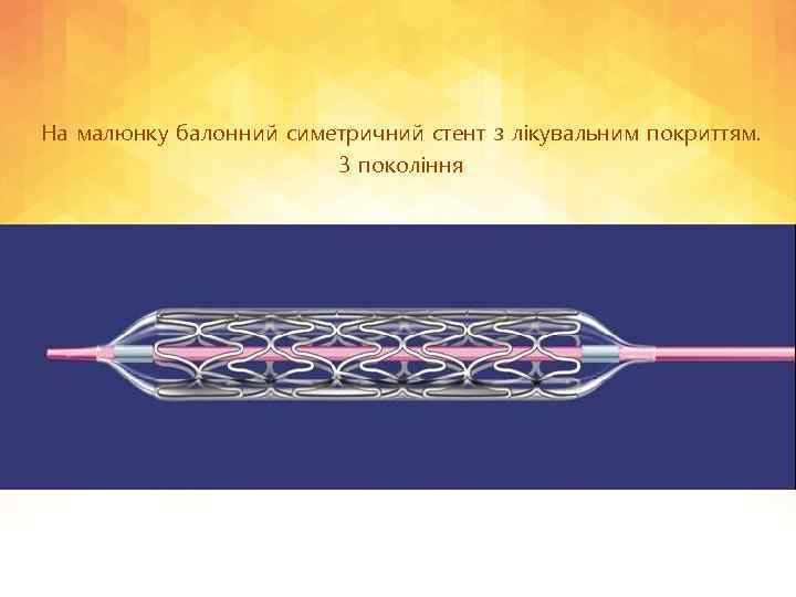 На малюнку балонний симетричний стент з лікувальним покриттям. 3 покоління 