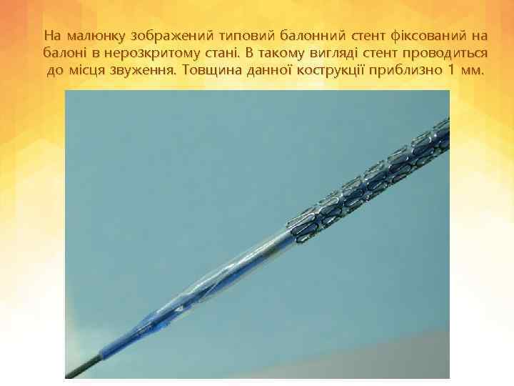 На малюнку зображений типовий балонний стент фіксований на балоні в нерозкритому стані. В такому