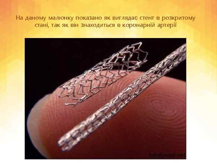 На даному малюнку показано як виглядає стент в розкритому стані, так як він знаходиться