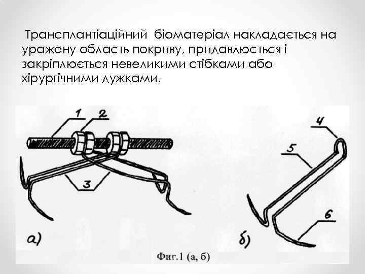 Трансплантіаційний біоматеріал накладається на уражену область покриву, придавлюється і закріплюється невеликими стібками або хірургічними