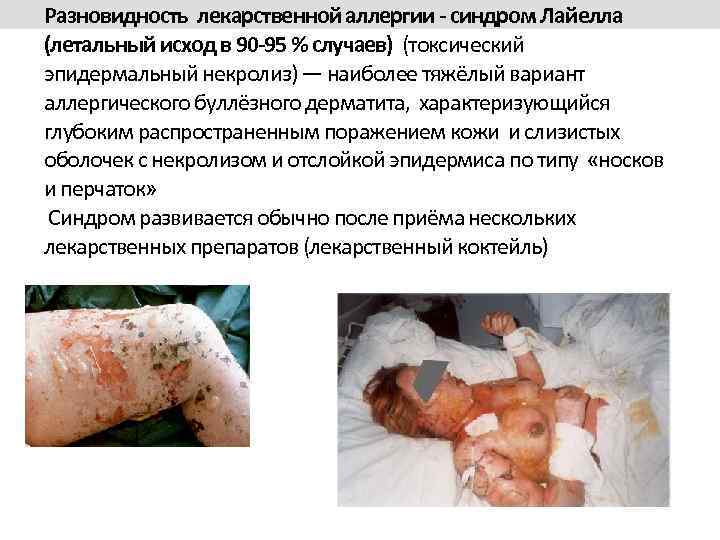 Разновидность лекарственной аллергии - синдром Лайелла (летальный исход в 90 -95 % случаев) (токсический
