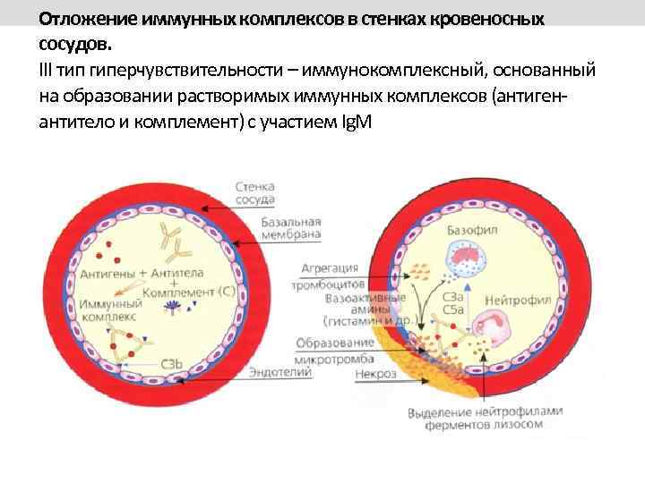 Отложение иммунных комплексов в стенках кровеносных сосудов. III тип гиперчувствительности – иммунокомплексный, основанный на