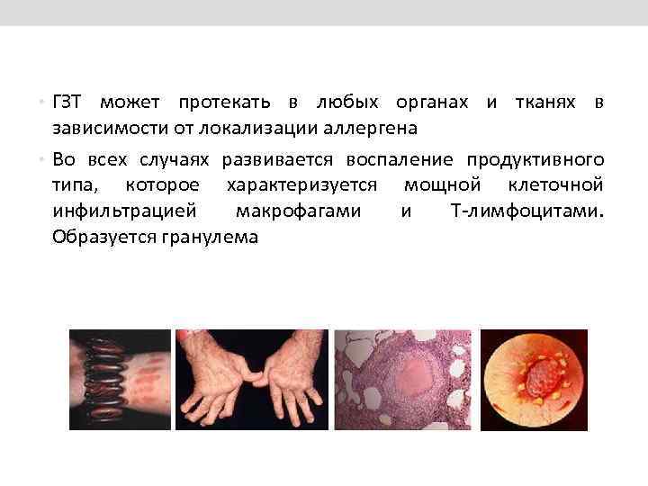  • ГЗТ может протекать в любых органах и тканях в зависимости от локализации