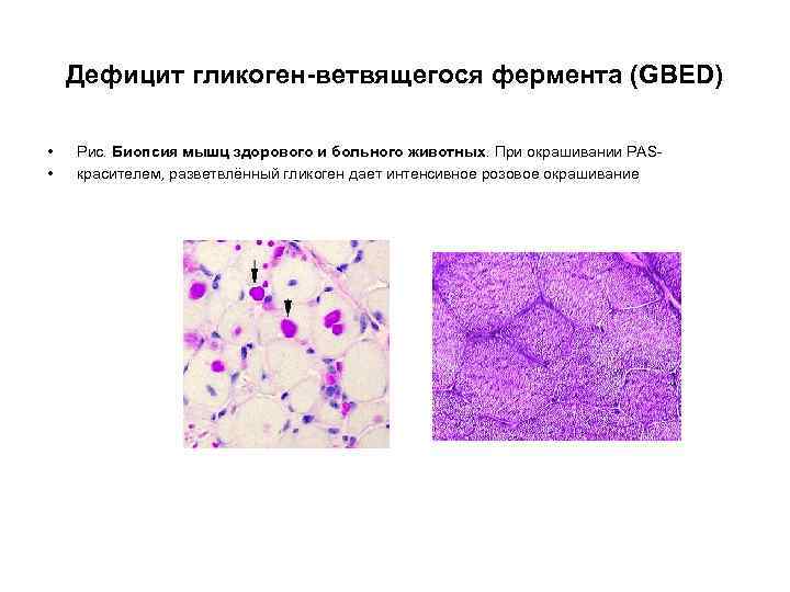 Дефицит гликоген-ветвящегося фермента (GBED) • • Рис. Биопсия мышц здорового и больного животных. При