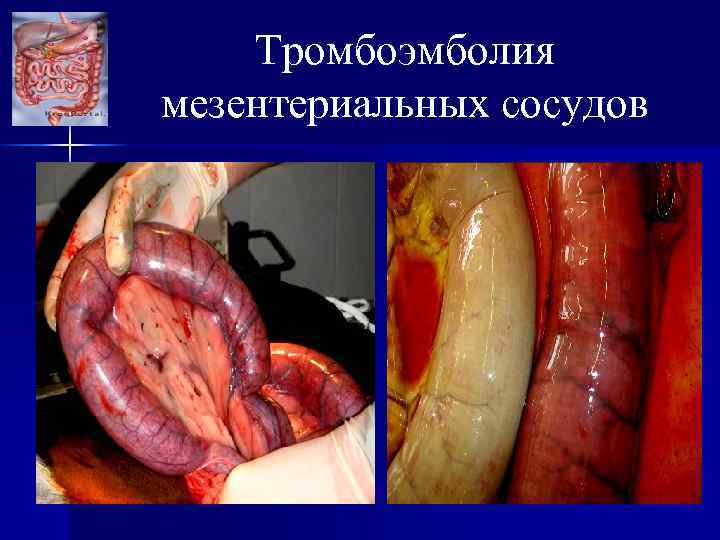 Тромбоэмболия мезентериальных сосудов 