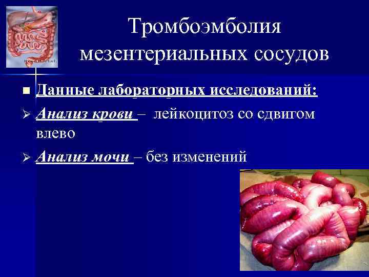 Тромбоэмболия мезентериальных сосудов Данные лабораторных исследований: Ø Анализ крови – лейкоцитоз со сдвигом влево