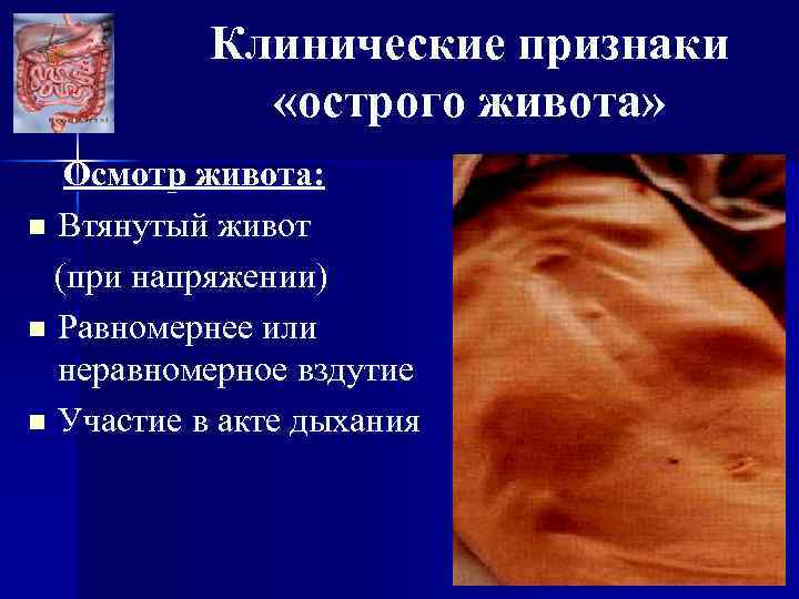 Клинические признаки «острого живота» Осмотр живота: n Втянутый живот (при напряжении) n Равномернее или