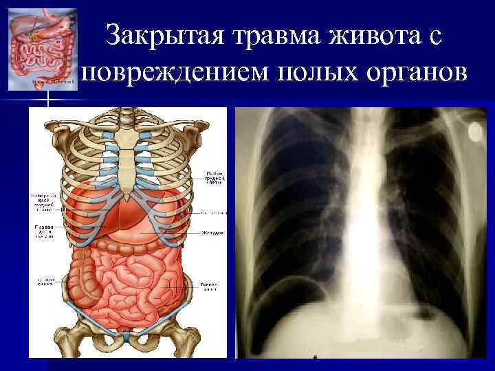 Клиническая картина острого живота