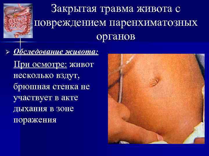 Закрытая травма живота с повреждением паренхиматозных органов Ø Обследование живота: При осмотре: живот несколько