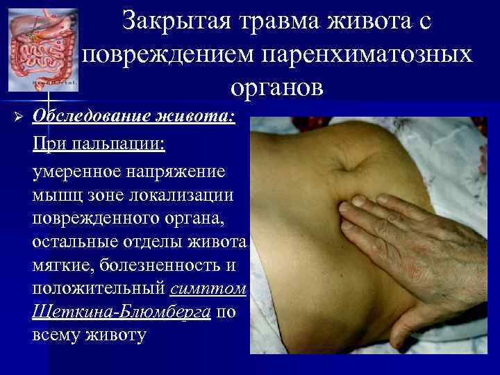 Закрытая травма живота с повреждением паренхиматозных органов Ø Обследование живота: При пальпации: умеренное напряжение