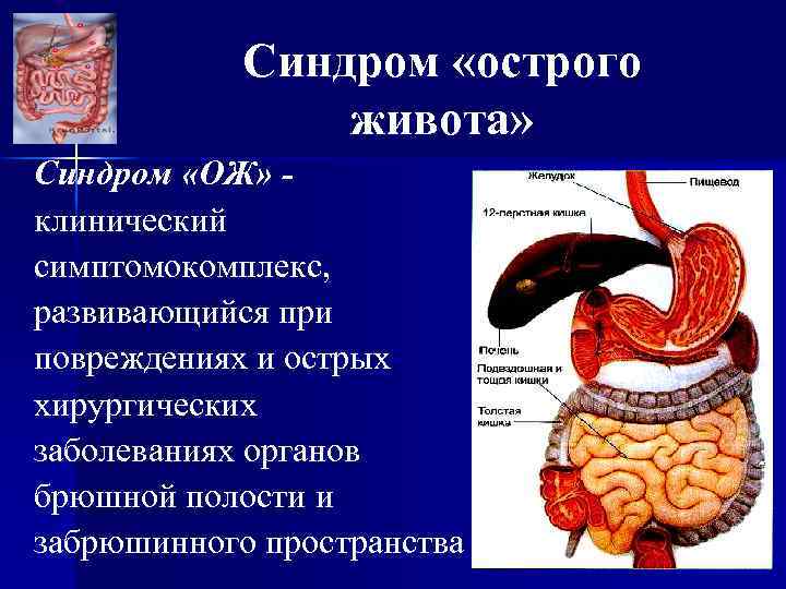 Синдром острого живота презентация