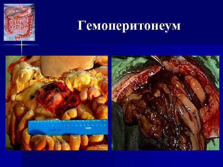 Гемоперитонеум 