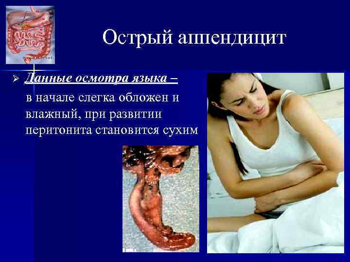 Острый аппендицит Ø Данные осмотра языка – в начале слегка обложен и влажный, при