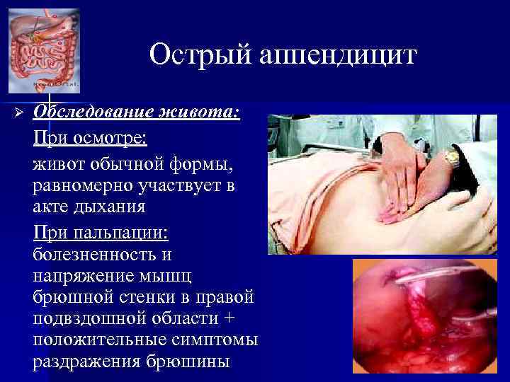 Острый аппендицит Ø Обследование живота: При осмотре: живот обычной формы, равномерно участвует в акте