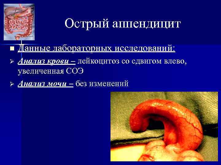 Острый аппендицит n Данные лабораторных исследований: Ø Анализ крови – лейкоцитоз со сдвигом влево,