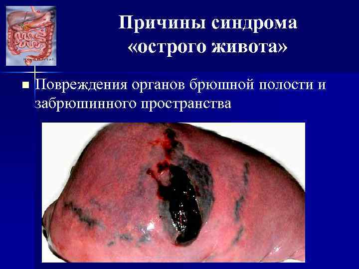 Причины синдрома «острого живота» n Повреждения органов брюшной полости и забрюшинного пространства 