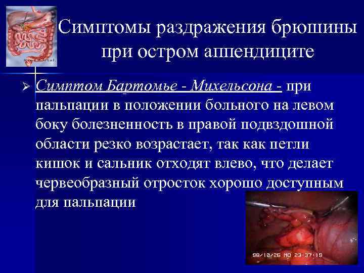 Симптомы раздражения брюшины при остром аппендиците Ø Симптом Бартомье - Михельсона - при пальпации