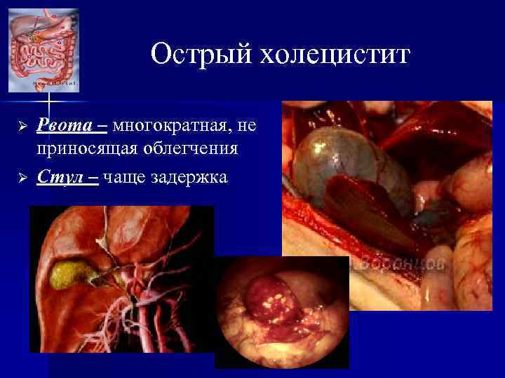 Острый холецистит Ø Ø Рвота – многократная, не приносящая облегчения Стул – чаще задержка
