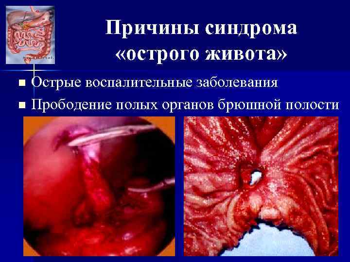 Причины синдрома «острого живота» Острые воспалительные заболевания n Прободение полых органов брюшной полости n