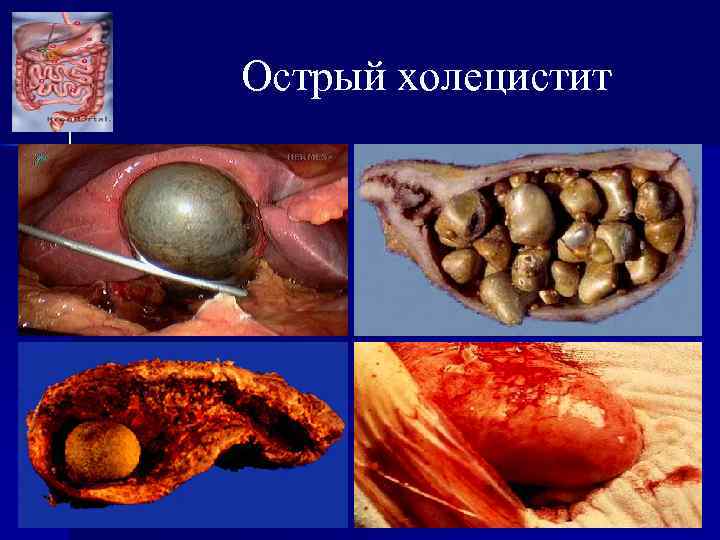 Острый холецистит 