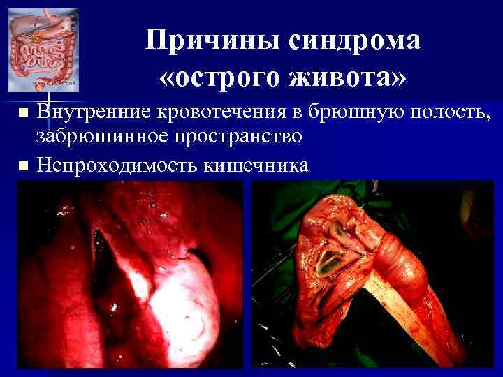 Причины синдрома «острого живота» Внутренние кровотечения в брюшную полость, забрюшинное пространство n Непроходимость кишечника
