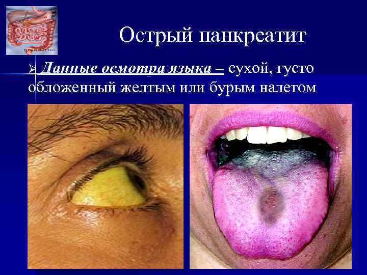 Острый панкреатит Данные осмотра языка – сухой, густо обложенный желтым или бурым налетом Ø