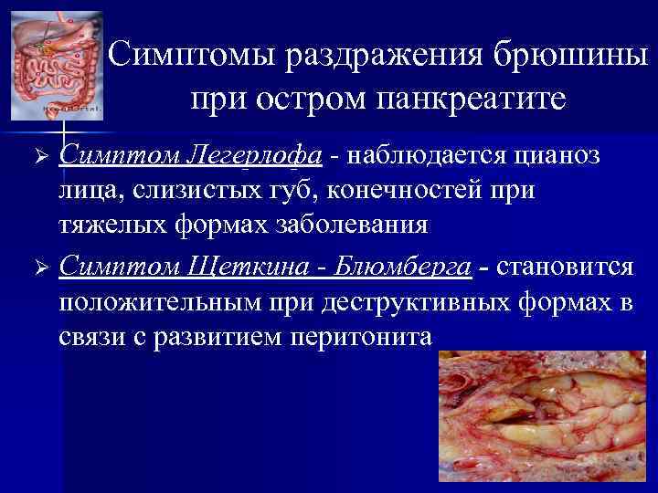 Симптомы раздражения брюшины при остром панкреатите Симптом Легерлофа - наблюдается цианоз лица, слизистых губ,