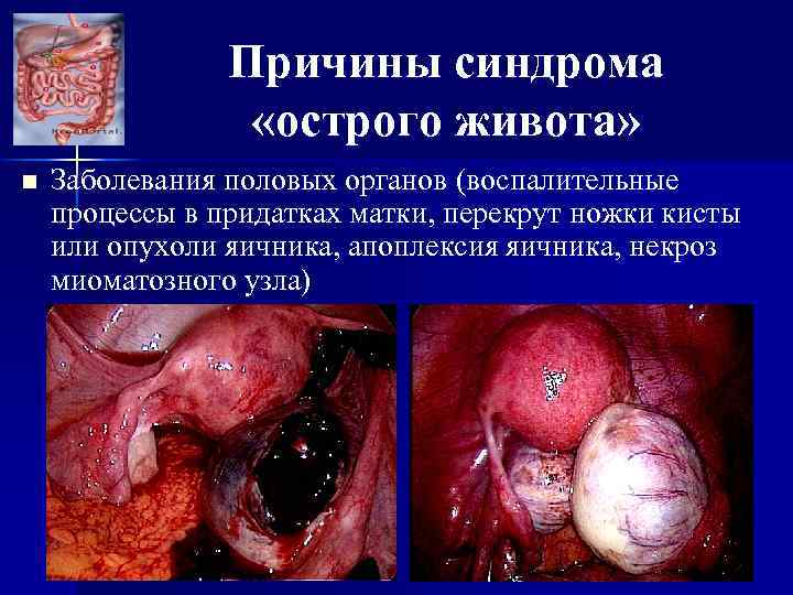 Причины синдрома «острого живота» n Заболевания половых органов (воспалительные процессы в придатках матки, перекрут